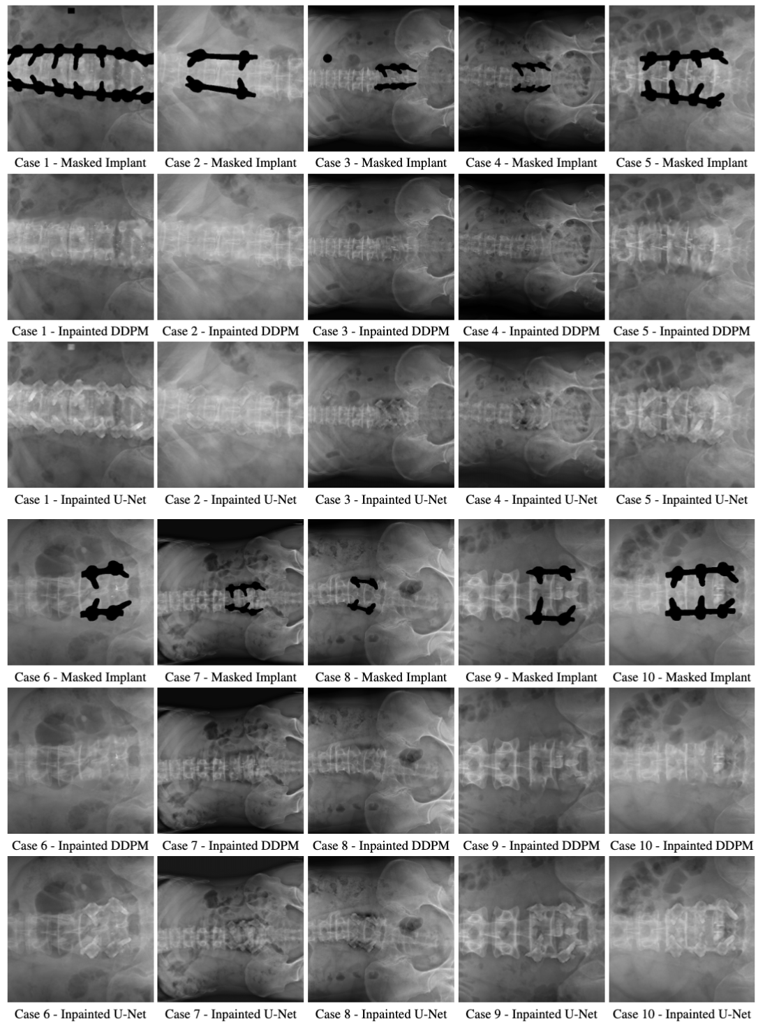 Inpainting results on 10 real clinical X-rays comparing DDPM and U-Net approaches
